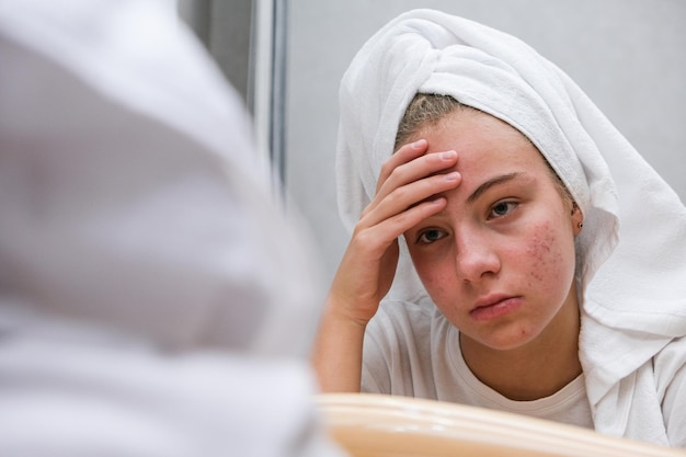 Acné. Une adolescente triste. Peau à problèmes chez les adolescents.