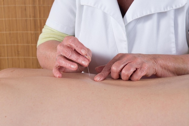 L'acupuncteur se prépare à taper l'aiguille dans la peau des patients