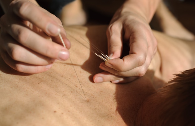 Acupuncture Médecins Chinois