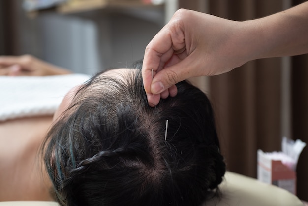 Acupuncture à la tête. Poil Glabre