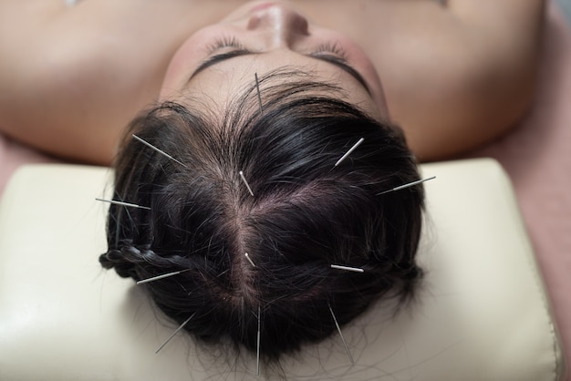 Acupuncture à la tête. Poil Glabre