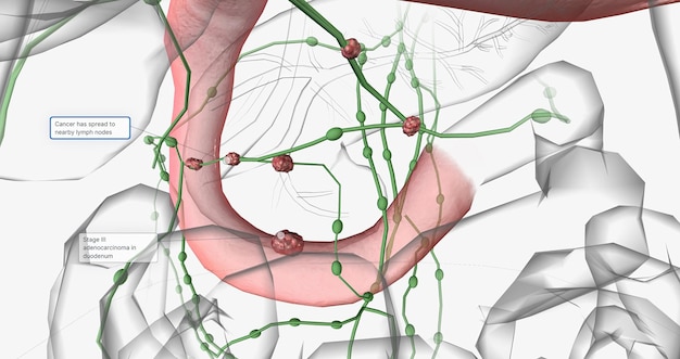 Adénocarcinome de stade III dans le duodénum