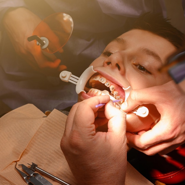 L'adolescent a un appareil dentaire collé à ses dents supérieures pour les redresser et le garçon a un écarteur sur les lèvres