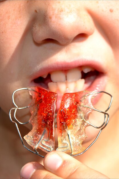 Photo adolescent portant un appareil orthodontique traitement dentaire pour améliorer l'écart de morsure