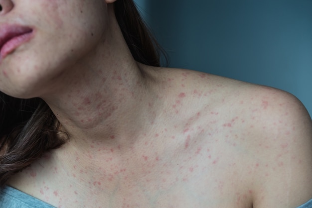 Allergie cutanée Symptômes du patient, Réaction allergique de la peau au cou et à la poitrine de la femme.