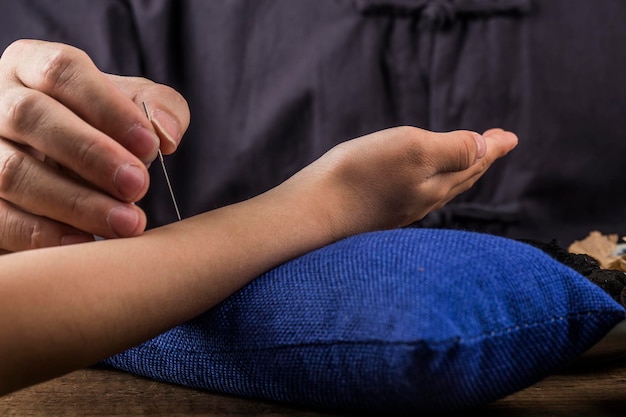 L'ancienne médecine chinoise donne l'acupuncture aux patients