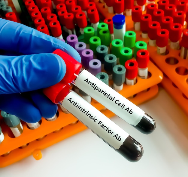 Antiparietal Cell Antibody et Intrinsic Factor Ac pour confirmer un diagnostic d'anémie pernicieuse.