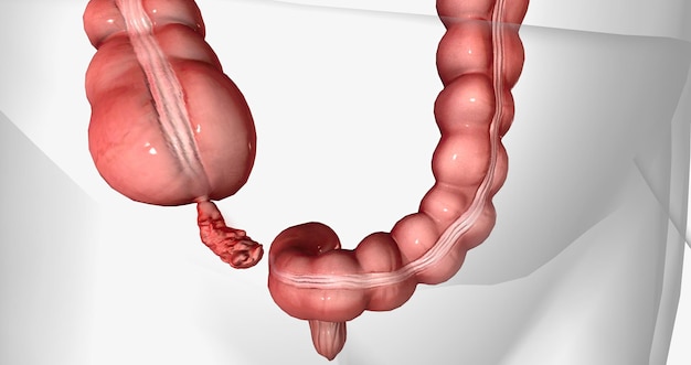 L'appendicite est l'inflammation de l'appendice, un organe mince en forme de tube attaché au gros intestin