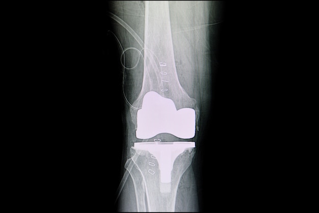 Arthroplastie totale du genou