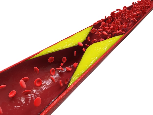 Athérosclérose de rendu 3D avec du sang de cholestérol ou de la plaque dans le vaisseau cause de la maladie coronarienne