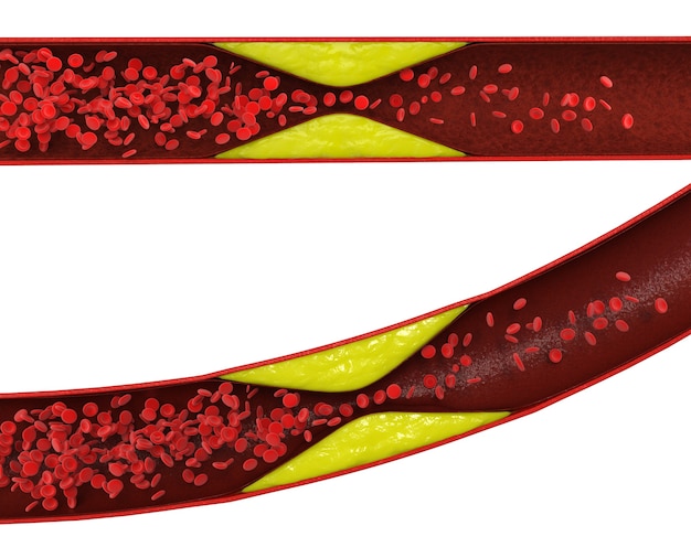 Athérosclérose de rendu 3D avec du sang de cholestérol ou de la plaque dans le vaisseau cause de la maladie coronarienne
