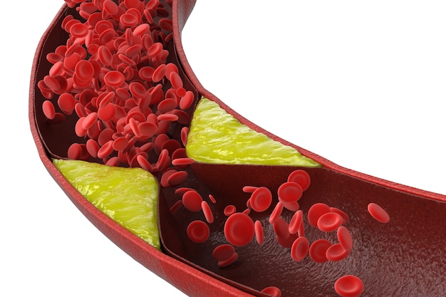 Athérosclérose de rendu 3D avec du sang de cholestérol ou de la plaque dans le vaisseau cause de la maladie coronarienne