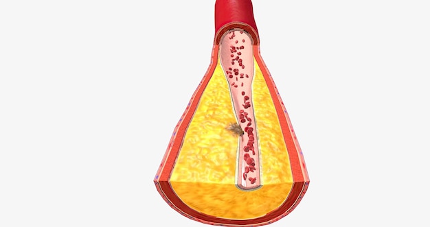 Photo l'athérothrombose est une maladie cardiovasculaire caractérisée par la rupture de la plaque athérosclérotique et la formation de caillots