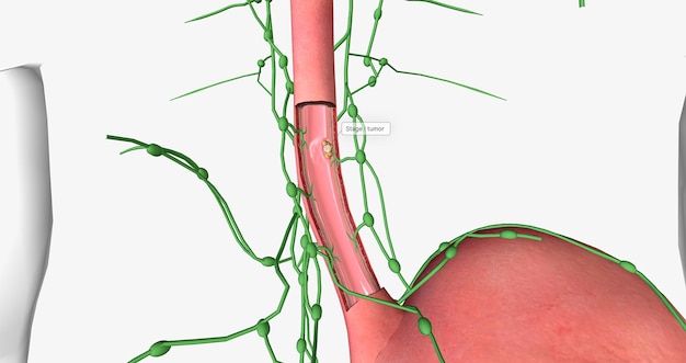 Au stade I du cancer de l'œsophage, la tumeur s'est propagée à travers certaines des couches de la paroi de l'œsophage