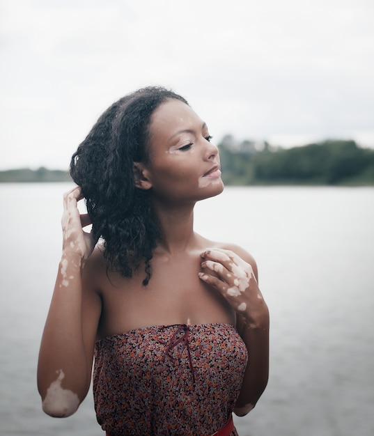 Belle jeune femme brune atteinte du vitiligo