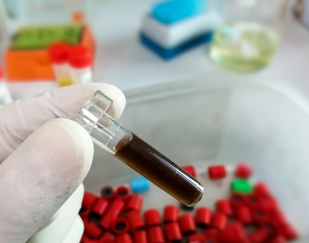 Le biochimiste détient un échantillon de liquide pleural avec fond de laboratoire, pour analyse biochimique.