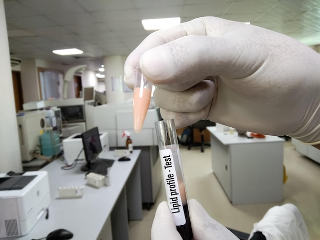 Le biochimiste tient un tube à essai avec un échantillon de sang lipémique. Haut triglycéride, LDL contient un échantillon de sang.