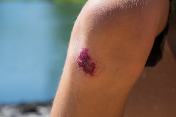 Blessure Douloureuse De La Peau Du Genou Du Genou écorché | Photo ...