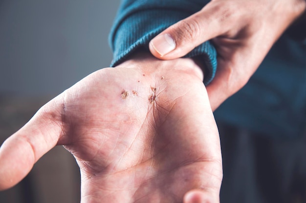 Blessure à la main de l'homme