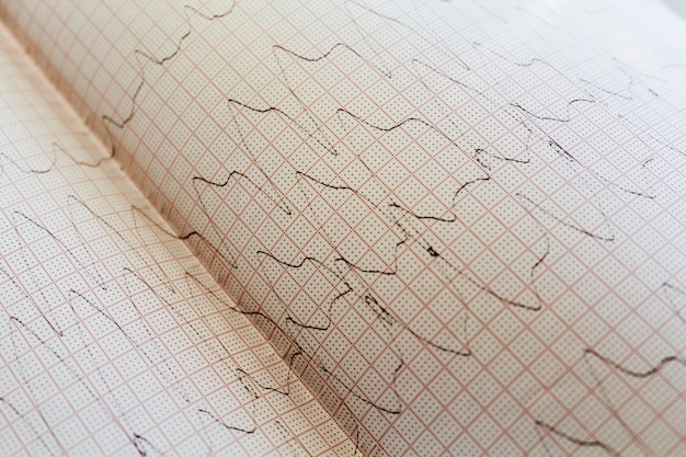 Bouchent la vue d&#39;un papier d&#39;électrocardiogramme.