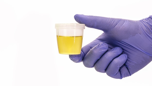 Bouteille de collecte d'urine tenue par une main gantée bleue Test d'urine EAS Urine pour texte et examen médical fond blanc isolé copyspace