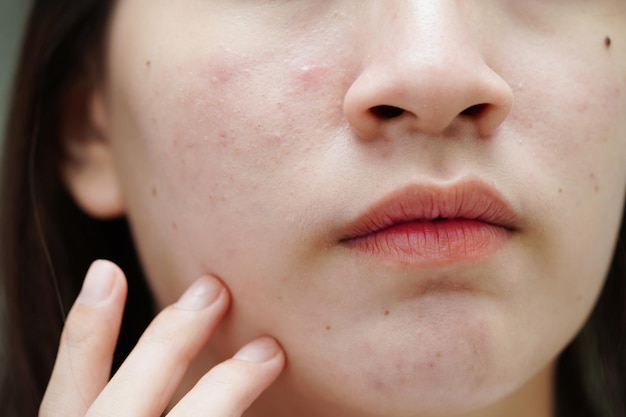 Photo bouton d'acné et cicatrice sur la peau visage troubles des glandes sébacées adolescente problème de beauté soins de la peau