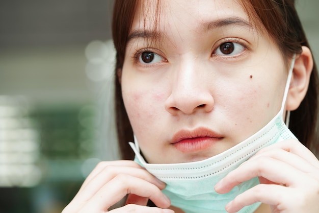 Bouton d'acné et cicatrice sur la peau visage troubles des glandes sébacées adolescente problème de beauté soins de la peau