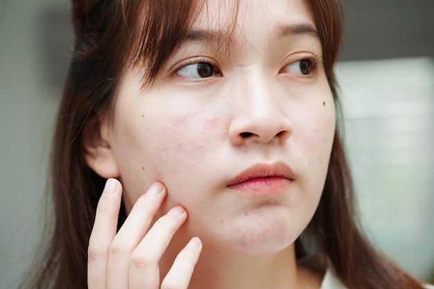 Bouton d'acné et cicatrice sur la peau visage troubles des glandes sébacées adolescente problème de beauté soins de la peau