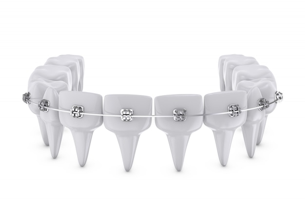 Brackets dentaires