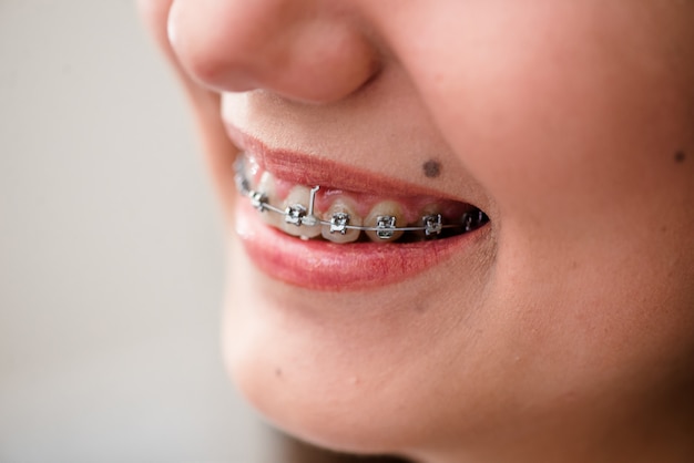Bretelles. Un traitement orthodontique. Concept de soins dentaires.