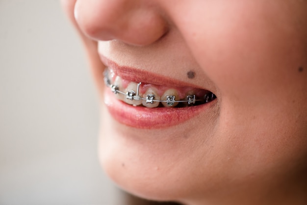 Bretelles. Un traitement orthodontique. Concept de soins dentaires.