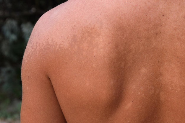 Photo brûlures solaires sur la peau du dos exfoliation de la peau peel off bronzage dangereux par le soleil