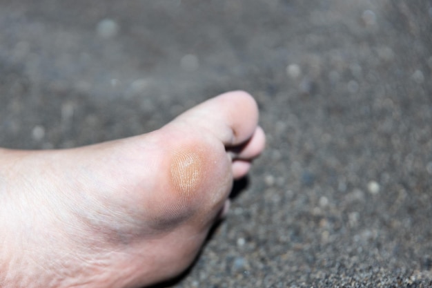 Photo callosité du pied de la femme sur le sable soins et santé des pieds