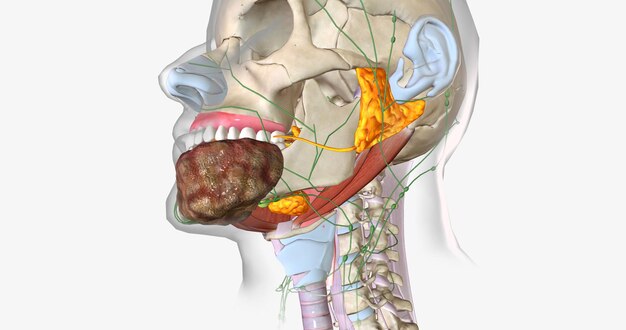 Photo le cancer buccal de stade quatre est invasif et s'est propagé au-delà du tissu dans lequel il est apparu pour la première fois