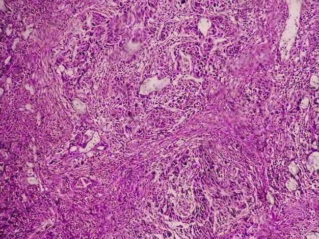 Carcinome à cellules transitionnelles de haut grade ou TCC a Cancer de la vessie ou carcinome urothélial