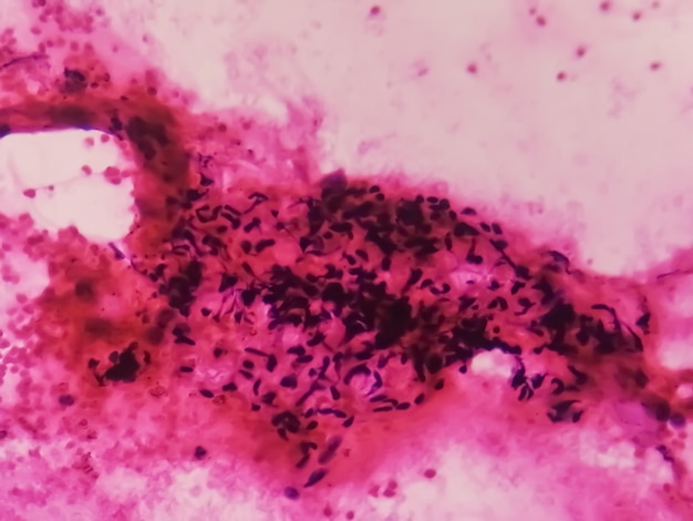 Photo carcinome à petites cellules sous microscopie