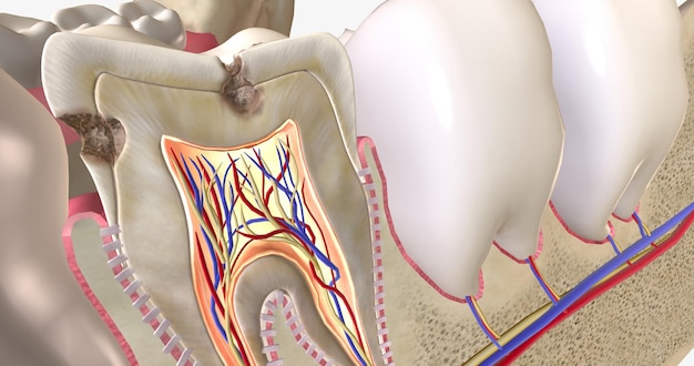 Les caries ou cavités dentaires sont des zones de carie dentaire causées par des bactéries productrices d'acide dans la bouche