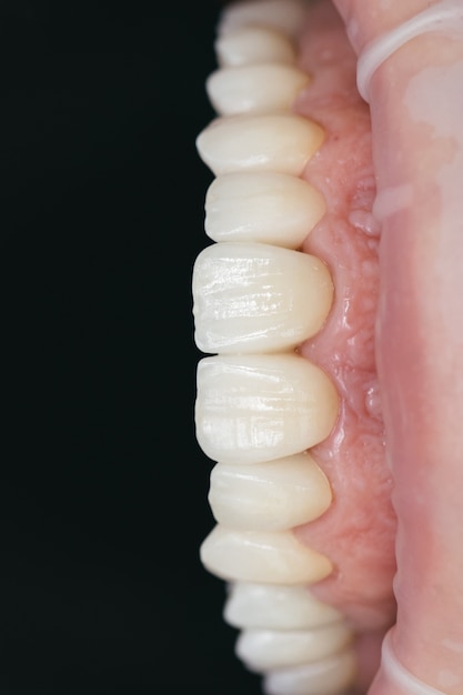 Céramique de zirconium en version finale. Teinture et glaçage. Conception de précision et matériaux de haute qualité. Soins de santé dentaire.