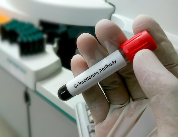 Échantillon de sang pour la sclérodermie pour le diagnostic de maladie auto-immune