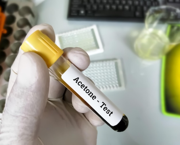 Échantillon de sang pour le test d'acétone pour l'acidocétose diabétique ou l'acidocétose alcoolique