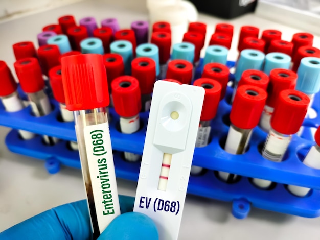 Échantillon de sang pour le test ADN PCR du virus Puumala. Test PUUV PCR ADN et entérovirus (EV) au laboratoire.