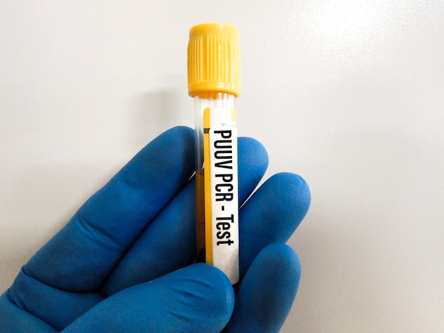 Échantillon de sang pour le test ADN PCR du virus Puumala. Test PUUV PCR ADN et entérovirus (EV) au laboratoire.