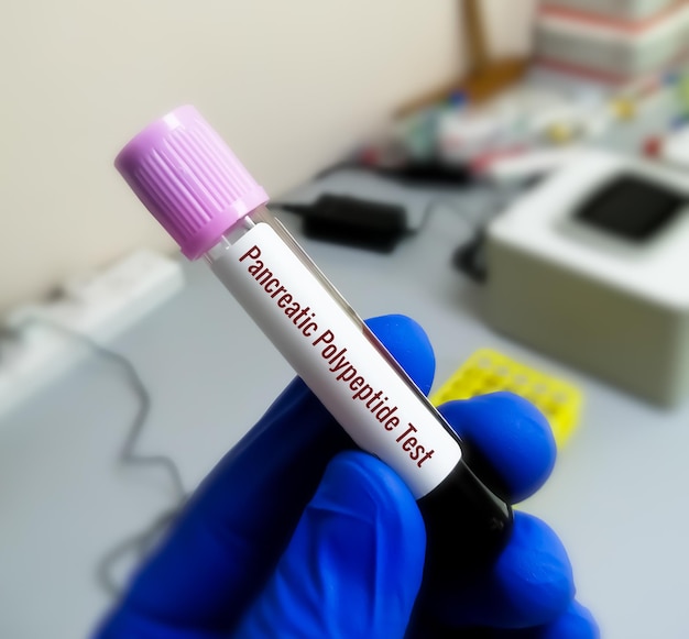 Échantillon de sang pour le test d'hormone pancréatique. Insuline, Glucagon.