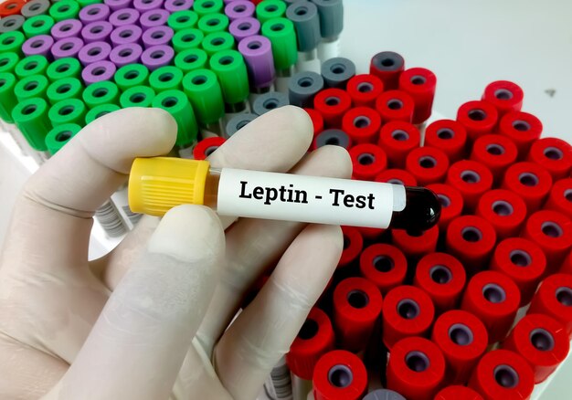 Échantillon de sang pour le test de leptine pour diagnostiquer les tests d'obésité