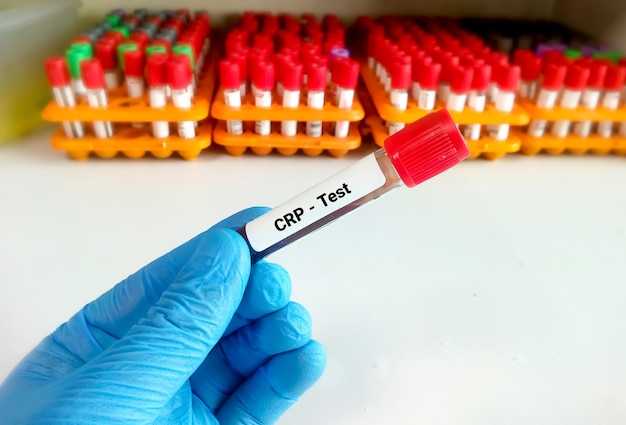 Échantillon de sang pour test de protéine C réactive ou CRP