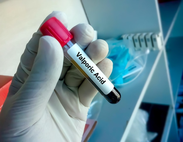 Échantillon de sang pour tester l'acide valproïque un test pour maintenir un niveau thérapeutique et surveiller la toxicité