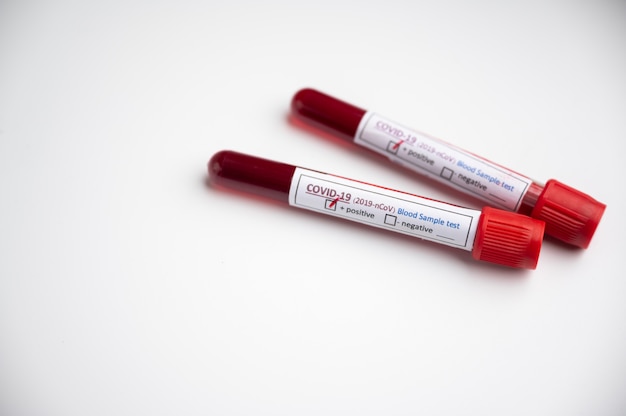 Échantillons de test sanguin pour la présence d'un tube de coronavirus (COVID-19) contenant un échantillon de sang qui a été testé positif pour le coronavirus