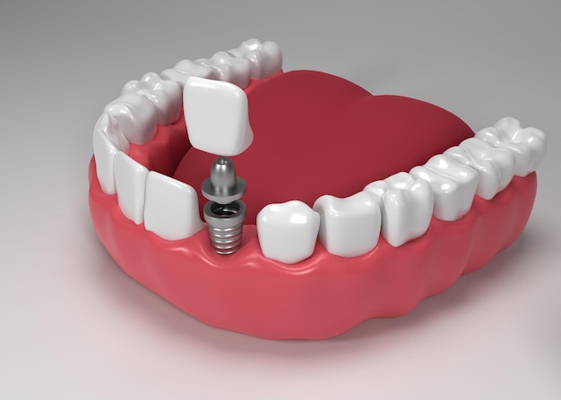 Chirurgie des implants dentaires rendu 3D