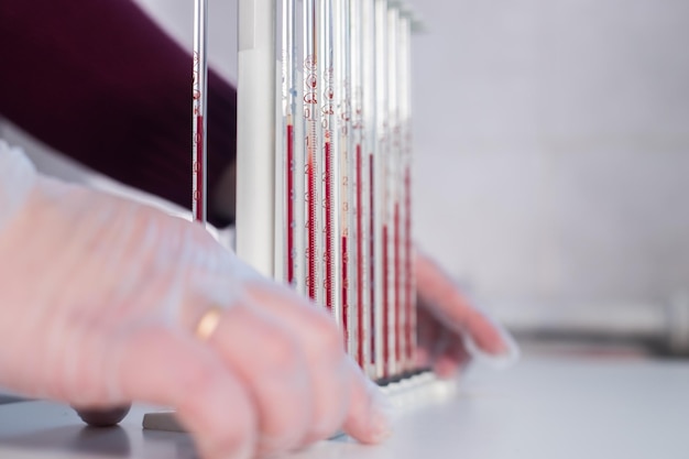 Clinique médicale un stand avec des pipettes remplies de sang une infirmière le tenant