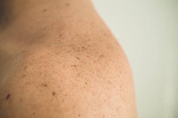 Close up detail de la peau nue sur le dos d'un homme avec des grains de beauté et des taches de rousseur. Vérification des grains de beauté bénins